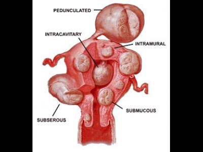 Fibrom uterin